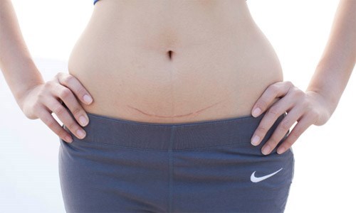 mổ đẻ những điều cần biết để tránh sẹo